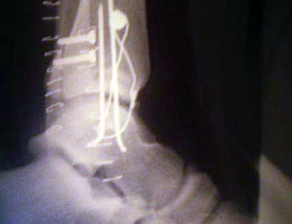 Fracture bimallolaire sur rception de backloop